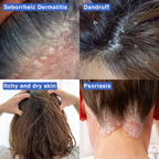Thatched™ Scalp Treatment Cream