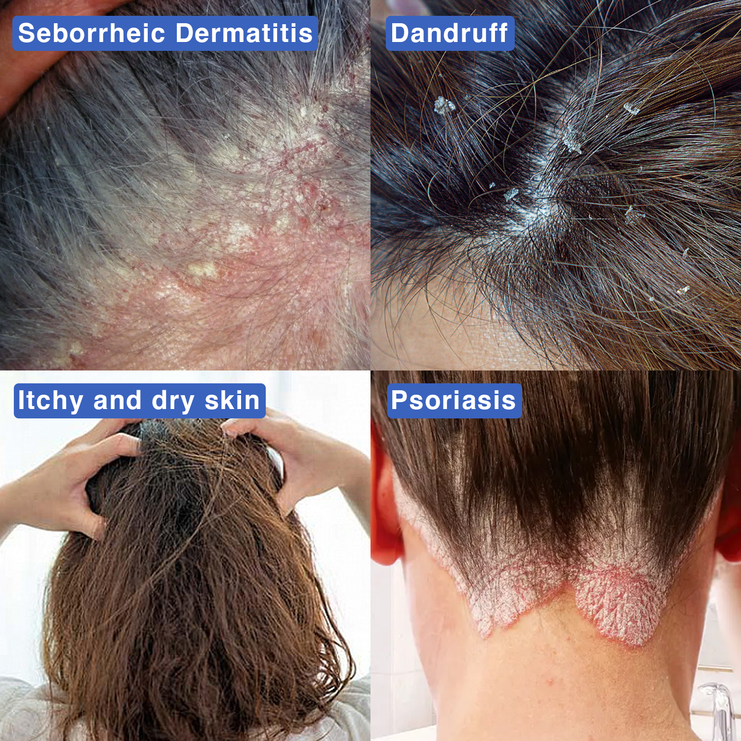 Thatched™ Scalp Treatment Cream
